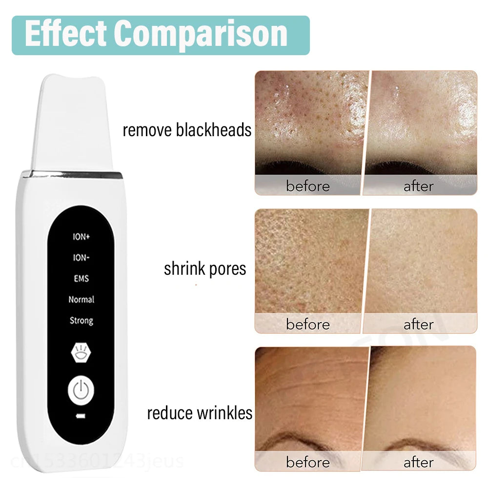 Peeling Blackhead Remover