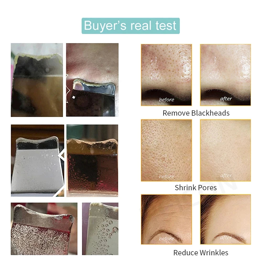 Peeling Blackhead Remover